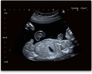 Ultraschall bei Schwangerschaft inkl. Organ-Screening in 1200 Wien